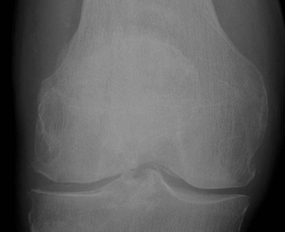 Patella Fracture Vertical